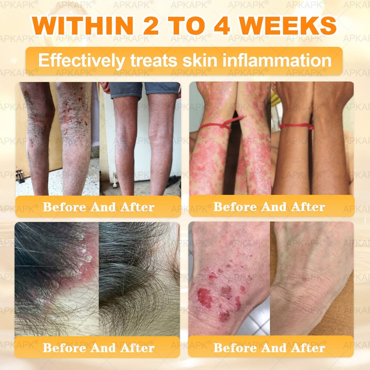 Official Store | 𝐀𝐏𝐊𝐀𝐏𝐊® 𝟖-𝐈𝐧-𝟏 𝐁𝐞𝐞 𝐕𝐞𝐧𝐨𝐦 & 𝐓𝐚𝐥𝐥𝐨𝐰 𝐒𝐤𝐢𝐧 𝐅𝐢𝐫𝐦𝐢𝐧𝐠 & 𝐓𝐫𝐞𝐚𝐭𝐦𝐞𝐧𝐭 𝐂𝐫𝐞𝐚𝐦 (Effective Within 7 Days)Bee Venom + Tallow · 7X Deep Hydration, targets wrinkles, sagging, stretch marks, dark spots, purpura, inflammations and more