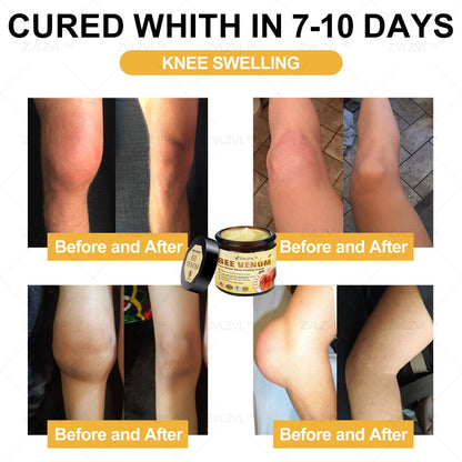 ZVLZVL™ Bee Venom Instant Pain Relief Arthritis Therapy Cream💪👨‍⚕️👨‍⚕️(Specially for older adults)