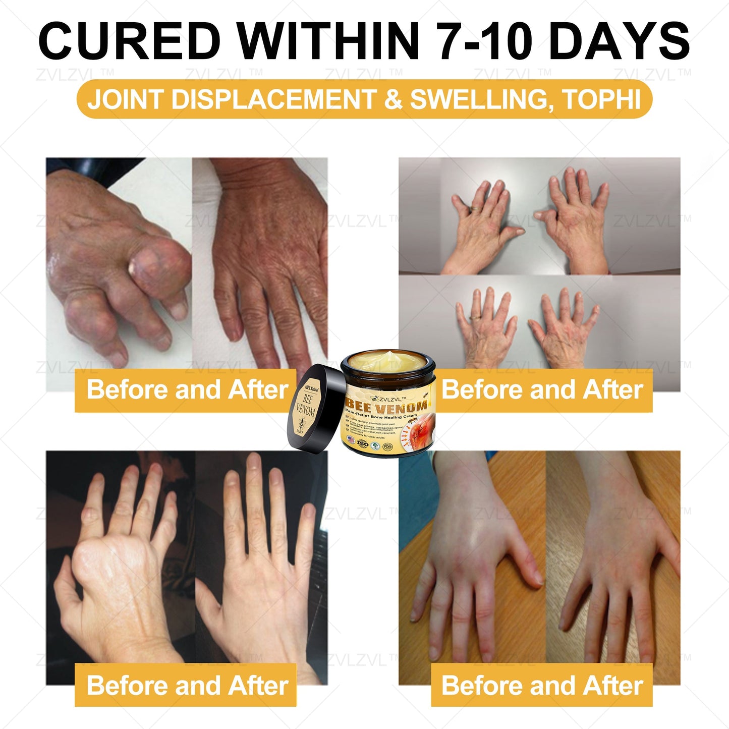 ZVLZVL™ Bee Venom Instant Pain Relief Arthritis Therapy Cream💪👨‍⚕️👨‍⚕️(Specially for older adults)