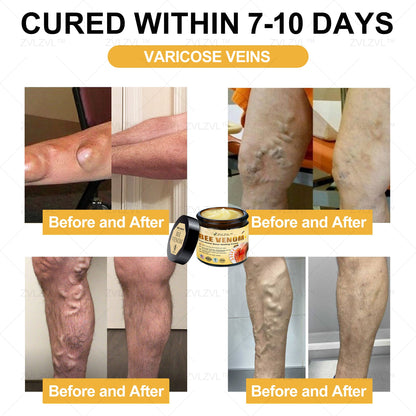 ZVLZVL™ Bee Venom Instant Pain Relief Arthritis Therapy Cream💪👨‍⚕️👨‍⚕️(Specially for older adults)