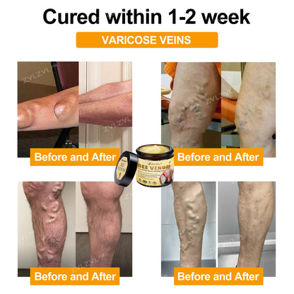 ZVLZVL™ Bee Venom Instant Pain Relief Arthritis Therapy Cream👨‍⚕️(Specially for older adults)